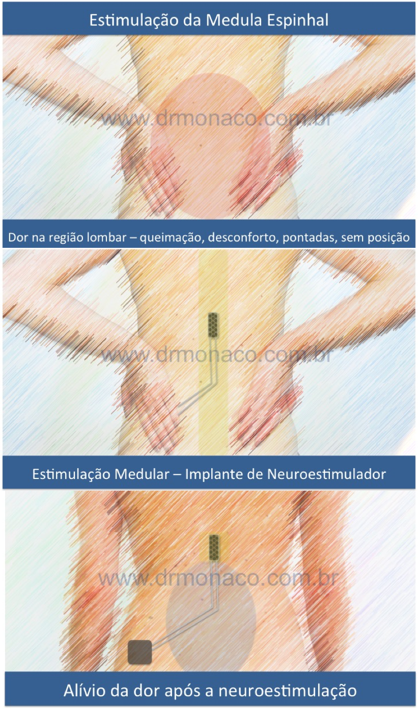 Esquema de funcionamento do Neuroestimulador Medular